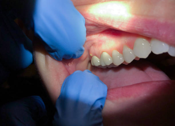 Best Emergency Root Canal Therapy in Crystal Lake, FL